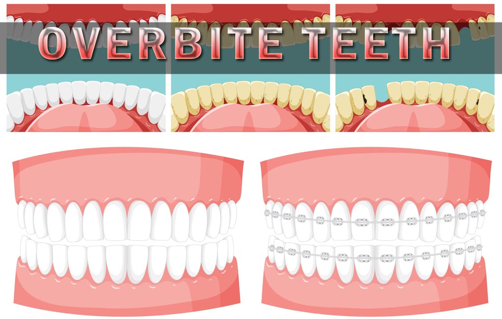overbite teeth
